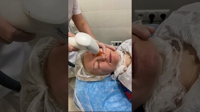 Лазерная шлифовка смотреть онлайн