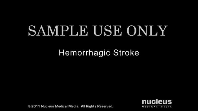 Stroke | Nucleus Health