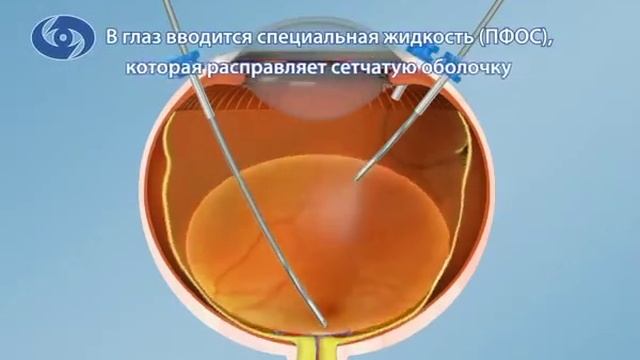 Лечение отслойки сетчатки витрэктомия смотреть онлайн
