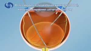 Лечение отслойки сетчатки  витрэктомия
