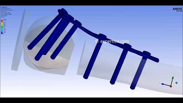 Virtually Testing the Locking Plate Used in Treating Proximal Humeral Fracture - ANSYS WB Explicit смотреть онлайн