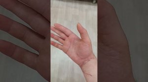 Повреждение сухожилий Сгибатели кисти, срединный и локтевой нерв Реабилитация #2