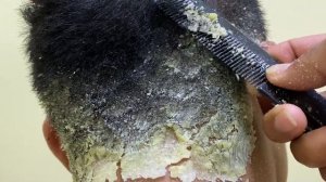 Царапины от перхоти большими хлопьями ( Big Flakes ) #649