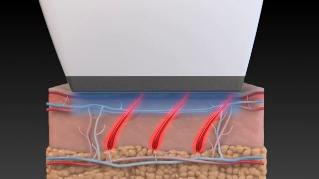 Аппарат Advantage, лазерная эпиляция смотреть онлайн