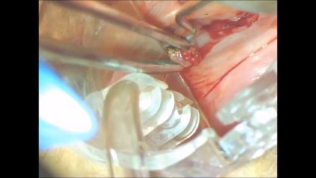 Удаление грануляционных полипов стенки влагалища диодным лазером под контролем кольпоскопа смотреть онлайн