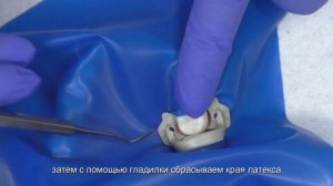 Методика наложения коффердама способ 1