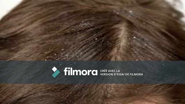 هاام للرجال والنساء !! علاج نهائى لقشرة الشعر смотреть онлайн