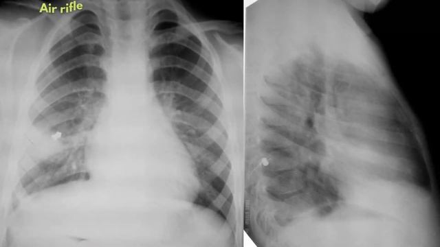 Foreign Bodies in The Body | Things Found In An Xray | Radiological Survey Images смотреть онлайн