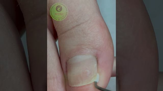 Тампонада Кополином