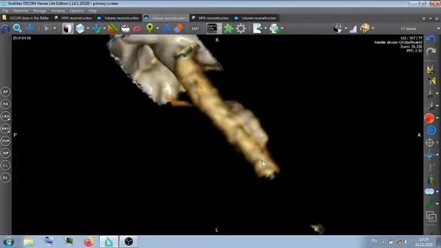 КТ АНГЕО ГОЛОВА ШЕЯ .ПЕРЕЛОМ ШИЛОВИДНЫХ ОТРОСТКОВ . смотреть онлайн