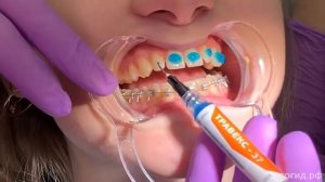 Ровные зубы за пол года на брекет-системе Experience (часть 2)