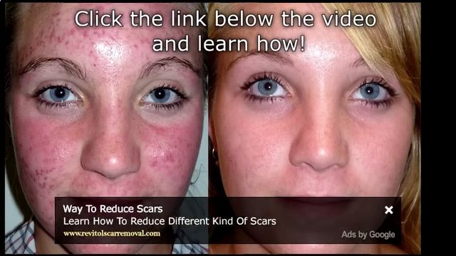 Watch Bio Oil Acne Scars: Before & After Results - Bio Oil Acne Scars Before And After смотреть онлайн