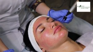 Фракционная мезотерапия