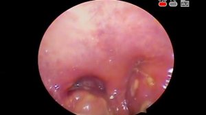 Лакунарная #ангина острый бактериальный #тонзиллит Acute #tonsillitis