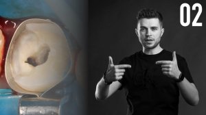 Уроки эндодонтии. Предэндодонтическое восстановление