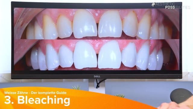 Endlich SCHÖNE & HELLE ZÄHNE ? - So kannst du Deine Zähne aufhellen - unser kompletter Guide! смотреть онлайн
