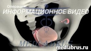 Лечение рака шейки матки