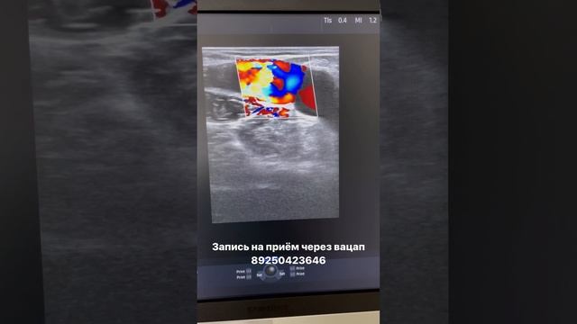 Обследование при варикозе. Узи сосудов. Лечение варикоза. Лечение вен. Флеболог. Флеболог Москва смотреть онлайн