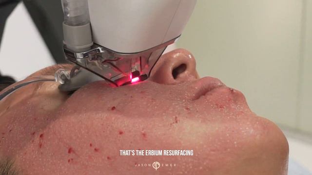 Get Rid of MyAcne Scars | COSMELAN, SUBCISION, BELLAFILL, HALO + PROFRACTIONAL LASER |Dr. Jason Eme смотреть онлайн