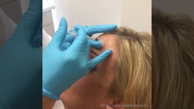 BOTOX INJECTIONS | Get Smoother skin in 2 weeks смотреть онлайн