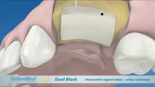 Aumento Horizontal con OsteoBiol DualBlock смотреть онлайн