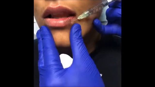 Skintology by Dr. Jennifer Walden | Juvederm Lip Fillers смотреть онлайн