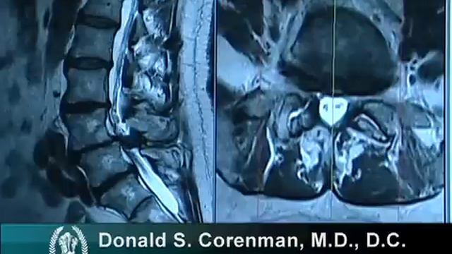 How to Read a MRI of Lumbar Degenerative Spondylolisthesis and Spinal Stenosis смотреть онлайн
