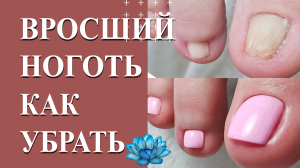 Вросший ноготь на большом пальце. Вырвнивание ногтей.