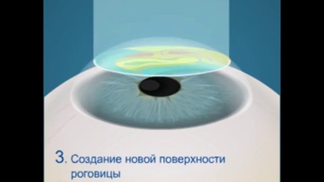 Супер Ласик — индивидуализированная лазерная коррекция