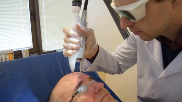 Лечение на розацея с Nd:Yag лазер Fotona смотреть онлайн