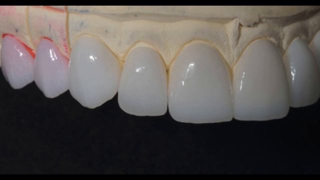 Виниры Зубной техник Александр Март смотреть онлайн