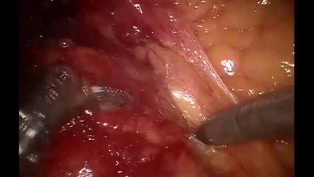 Robotic Retroperitoneal Lymph Node Dissection with Associated Duplicated Vena Cava смотреть онлайн