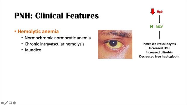Paroxysmal Nocturnal Hemoglobinuria (PNH) | Causes & Pathogenesis, Symptoms, Diagnosis & Treatment смотреть онлайн