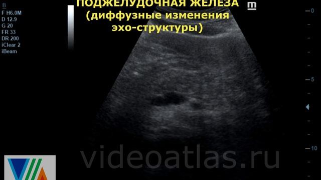 Диффузные изменения поджелудочной железы смотреть онлайн
