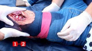 Алгоритм оказания помощи при открытом переломе
