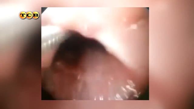 Что делать, если ребёнок засунул предмет в нос смотреть онлайн