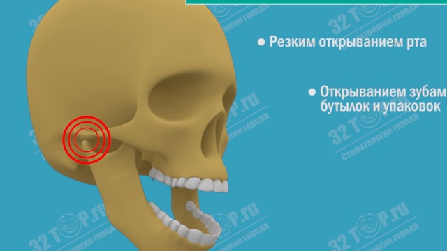 Вывих челюсти. Вывих нижней челюсти.