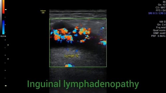 Inguinal lymphadenopathy смотреть онлайн