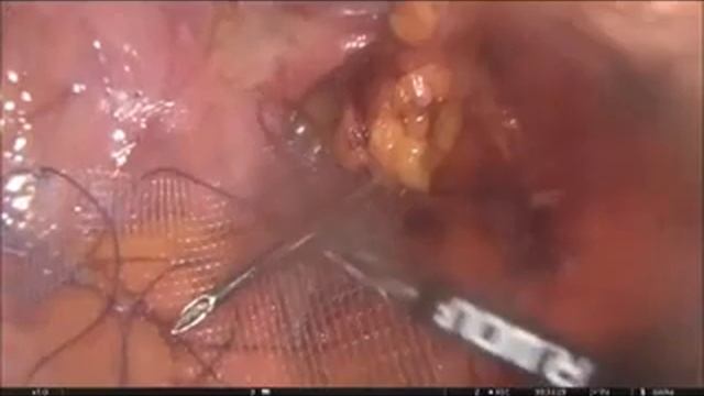 Лапароскопия при хроническом калькулёзном холецистите и паховой грыже смотреть онлайн