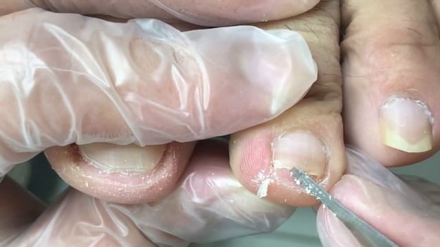 Toenails Haven’t Been Trimmed For 2 Months, Cleaning Ingrown Toenails【Crazy Pedicure Room】