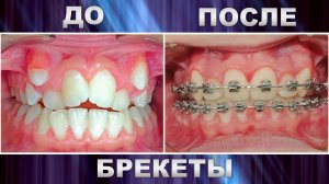 Исправление прикуса ДО/ПОСЛЕ ортодонтического лечения