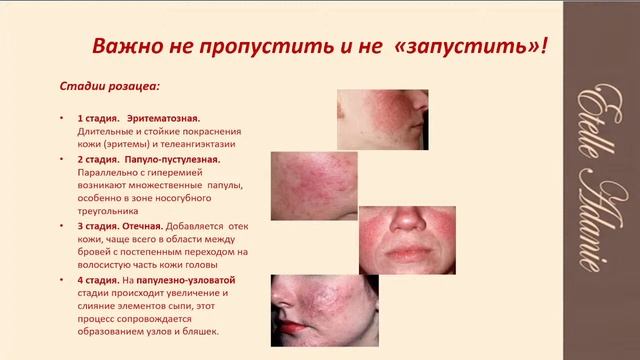 Красные щечки — признак болезни. Проверьте себя! Как убрать покраснения и сосудистые сеточки на лиц