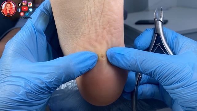 Стержневая мозоль удаление / Заноза из волоса? смотреть онлайн