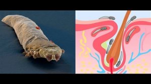 Демодекс: подкожные клещи на лице – что делать?