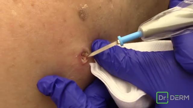 *THROWBACK* Massive Blackhead Removal POW!| Dr. Derm