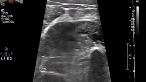 УЗИ вен. Суральный тромбоз. Женщина.