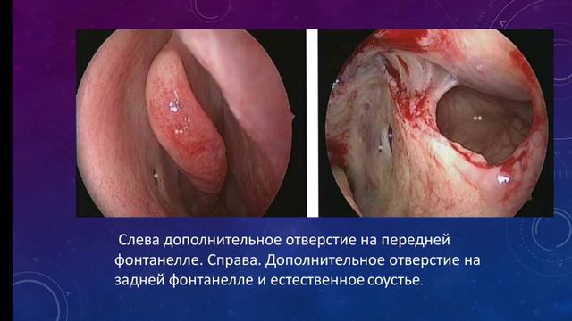 Лор.Верхнечелюстная пазуха. смотреть онлайн