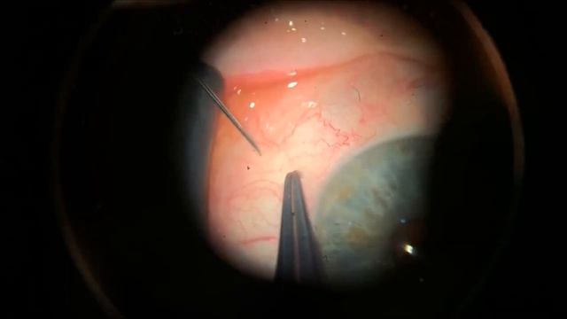 Техника интравитреальных инъекций смотреть онлайн