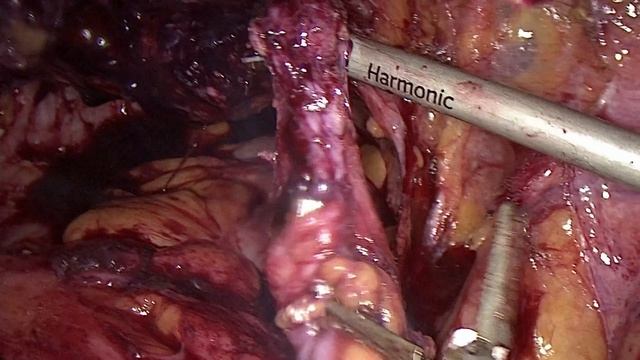 экстирпация культи шейки матки или почему не стоит делать ампутацию матки смотреть онлайн