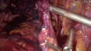 экстирпация культи шейки матки или почему не стоит делать ампутацию матки